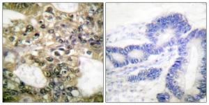 Immunohistochemical analysis of paraffin-embedded human colon carcinoma tissue using Anti-HDAC6 Antibody The right hand panel represents a negative control, where the antibody was pre-incubated with the immunising peptide