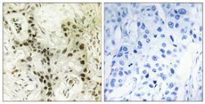 Immunohistochemical analysis of paraffin-embedded human breast carcinoma tissue using Anti-FOXI1 Antibody. The right hand panel represents a negative control, where the antibody was pre-incubated with the immunising peptide