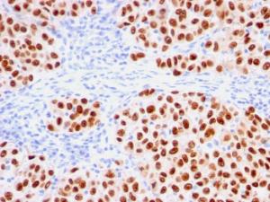 Immunohistochemical analysis of formalin-fixed, paraffin-embedded human melanoma using Anti-SOX10 Antibody [rSOX10/1074]