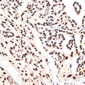 Immunohistochemistry analysis of paraffin-embedded human thyroid cancer using Anti-PHAPI2/APRIL Antibody [ARC2014] (A307147) at a dilution of 1:100 (40x lens) Perform microwave antigen retrieval with 10 mM Tris/EDTA buffer pH 90 before commencing with IHC staining protocol