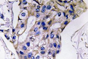 Immunohistochemical analysis of paraffin-embedded human breast carcinoma tissue using Anti-IL-5 Antibody