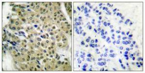 Immunohistochemical analysis of paraffin-embedded human breast cancer using Anti-HDAC5 Antibody 1:100 (4°C overnight) The right hand panel represents a negative control, where the antibody was pre-incubated with the immunising peptide