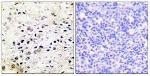 Immunohistochemical analysis of paraffin-embedded human prostate cancer using Anti-HDAC5 Antibody 1:100 (4°C overnight) The right hand panel represents a negative control, where the antibody was pre-incubated with the immunising peptide