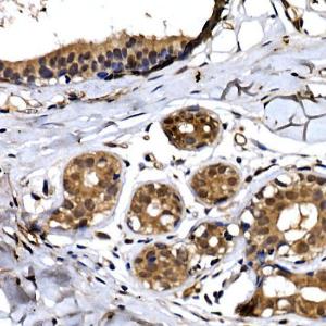 Immunohistochemistry analysis of paraffin-embedded human breast cancer tissue using Anti-Beta TRCP / HOS Antibody (A307151) at a dilution of 1:50 (40x lens). Perform high pressure antigen retrieval with 10 mM citrate buffer pH 6.0 before commencing with IHC staining protocol.