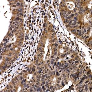 Immunohistochemistry analysis of paraffin-embedded human colon carcinoma tissue using Anti-Beta TRCP / HOS Antibody (A307151) at a dilution of 1:50 (40x lens). Perform high pressure antigen retrieval with 10 mM citrate buffer pH 6.0 before commencing with IHC staining protocol.