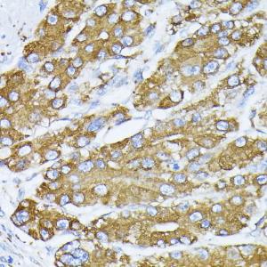 Immunohistochemistry analysis of paraffin-embedded human liver cancer using Anti-GRP78 BiP Antibody (A12567) at a dilution of 1:100 (40X lens). Perform microwave antigen retrieval with 10 mM PBS buffer pH 7.2 before commencing with IHC staining protocol