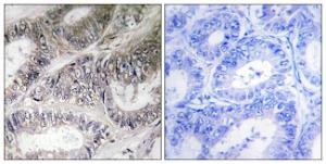 Immunohistochemical analysis of paraffin-embedded human colon carcinoma tissue using Anti-COX19 Antibody. The right hand panel represents a negative control, where the Antibody was pre-incubated with the immunising peptide