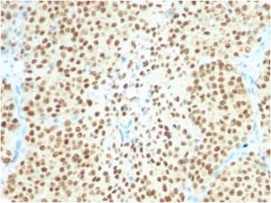 Immunohistochemical analysis of formalin-fixed, paraffin-embedded human melanoma using Anti-SOX10 Antibody [SOX10/2311R]