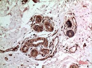 Immunohistochemical analysis of paraffin-embedded human breast cancer using Anti-IL10 Antibody