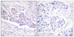 Immunohistochemical analysis of paraffin-embedded human breast carcinoma using Anti-FOXO1A (phospho Ser329) Antibody The right hand panel represents a negative control, where the antibody was pre-incubated with the immunising peptide