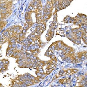 Immunohistochemistry analysis of paraffin-embedded human lung cancer using Anti-IRS1 Antibody (A12569) at a dilution of 1:100 (40x lens). Perform high pressure antigen retrieval with 10 mM citrate buffer pH 6.0 before commencing with IHC staining protocol.