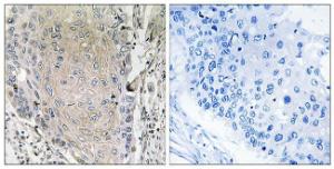 Immunohistochemical analysis of paraffin-embedded human lung carcinoma tissue using Anti-CBLN3 Antibody The right hand panel represents a negative control, where the antibody was pre-incubated with the immunising peptide