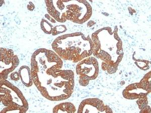 Immunohistochemical analysis of formalin-fixed, paraffin-embedded human colon carcinoma using Anti-Cytokeratin 18 Antibody [DE-K18]