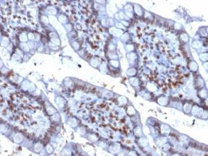 Immunohistochemical analysis of formalin-fixed, paraffin-embedded human colon carcinoma using Anti-PU.1 Antibody [PU1/2146]