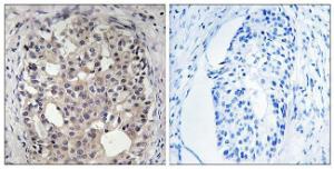 Immunohistochemical analysis of paraffin-embedded human breast carcinoma using Anti-CDC25A (phospho Ser178) Antibody. The right hand panel represents a negative control, where the antibody was pre-incubated with the immunising peptide