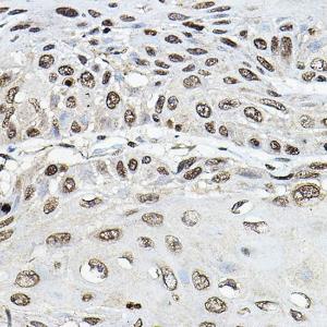 Immunohistochemistry analysis of paraffin-embedded human esophageal cancer using Anti-TRRAP Antibody (A308201) at a dilution of 1:100 (40x lens) Perform microwave antigen retrieval with 10 mM PBS buffer pH 72 before commencing with IHC staining protocol