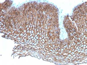 Immunohistochemical analysis of formalin-fixed, paraffin-embedded human esophageal carcinoma using Anti-Desmoglein 3 Antibody [DSG3/2837]