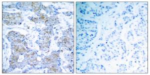 Immunohistochemical analysis of paraffin-embedded human breast carcinoma tissue using Anti-HER2 Antibody. The right hand panel represents a negative control, where the antibody was pre-incubated with the immunising peptide