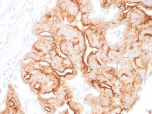 Immunohistochemical analysis of formalin-fixed, paraffin-embedded human ovarian carcinoma using Anti-MUC16 Antibody [MUC16/1860]