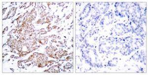 Immunohistochemical analysis of paraffin-embedded human breast carcinoma using Anti-Myc (phospho Thr58) Antibody. The right hand panel represents a negative control, where the antibody was pre-incubated with the immunising peptide.