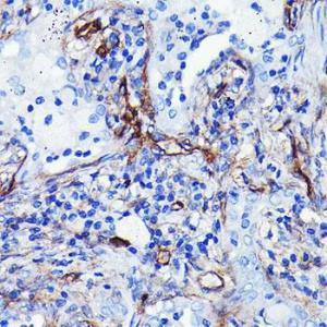 Immunohistochemistry analysis of paraffin-embedded human lung cancer using Anti-CD105 Antibody [ARC0446] (A307167) at a dilution of 1:100 (40x lens). Perform microwave antigen retrieval with 10 mM PBS buffer pH 7.2 before commencing with IHC staining protocol.