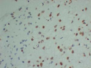 Immunohistochemical analysis of paraffin-embedded human Astrocytoma-high magnification using Anti-INI 1 Antibody