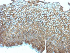 Immunohistochemical analysis of formalin-fixed, paraffin-embedded human esophageal carcinoma using Anti-Desmoglein 3 Antibody [DSG3/2839]