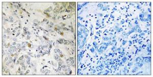 Immunohistochemical analysis of paraffin-embedded human breast carcinoma tissue using Anti-HCC1 Antibody. The right hand panel represents a negative control, where the antibody was pre-incubated with the immunising peptide.