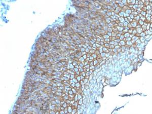 Immunohistochemical analysis of formalin-fixed, paraffin-embedded human esophageal carcinoma using Anti-Desmoglein 3 Antibody [DSG3/2839]