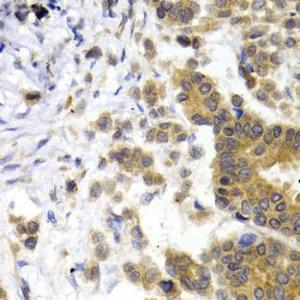 Immunohistochemistry analysis of paraffin-embedded human breast cancer tissue using Anti-68kDa Neurofilament/NF-L Antibody (A12580) at a dilution of 1:200 (40x lens) Perform microwave antigen retrieval with 10 mM PBS buffer pH 72 before commencing with IHC staining protocol