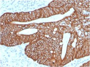 Immunohistochemical analysis of formalin-fixed, paraffin-embedded human colon carcinoma using Anti-Cytokeratin 18 Antibody [KRT18/2819R]