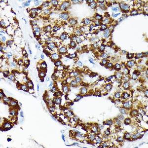 Immunohistochemistry analysis of paraffin-embedded human liver cancer using Anti-HSPA4 Antibody [ARC2237] (A305695) at a dilution of 1:100 (40x lens). Perform microwave antigen retrieval with 10 mM Tris/EDTA buffer pH 9.0 before commencing with IHC staining protocol.