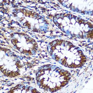 Immunohistochemistry analysis of paraffin-embedded human colon tissue using Anti-NM23A Antibody (A12581) at a dilution of 1:100 (40X lens). Perform microwave antigen retrieval with 10 mM PBS buffer pH 7.2 before commencing with IHC staining protocol