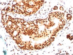 Immunohistochemical analysis of formalin-fixed, paraffin-embedded human breast carcinoma using Anti-SUMO-2 + SUMO-3 Antibody [SM23/496]