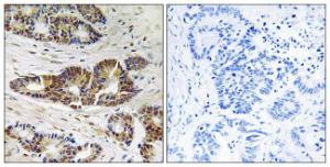 Immunohistochemical analysis of paraffin-embedded human colon carcinoma tissue using Anti-GRK2 Antibody. The right hand panel represents a negative control, where the Antibody was pre-incubated with the immunising peptide