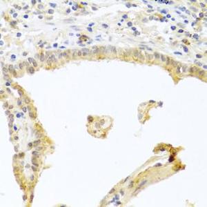 Immunohistochemistry analysis of paraffin-embedded human lung cancer using Anti-PKC alpha Antibody (A12587) at a dilution of 1:100 (40x lens). Perform microwave antigen retrieval with 10 mM PBS buffer pH 7.2 before commencing with IHC staining protocol.