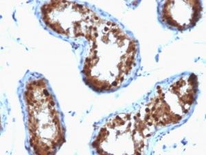 Immunohistochemical analysis of formalin-fixed, paraffin-embedded human testicular carcinoma using Anti-SUMO-2 + SUMO-3 Antibody [SPM572]