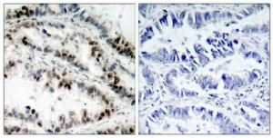 Immunohistochemical analysis of paraffin-embedded human lung carcinoma using Anti-SMC1 (phospho Ser957) Antibody. The right hand panel represents a negative control, where the antibody was pre-incubated with the immunising peptide.