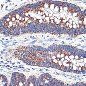 Immunohistochemistry analysis of paraffin-embedded human colon carcinoma tissue using Anti-TTC11/FIS1 Antibody [ARC5010-01] (A307193) at a dilution of 1:100 (40X lens). Perform microwave antigen retrieval with 10 mM Tris/EDTA buffer pH 9.0 before commencing with IHC staining protocol