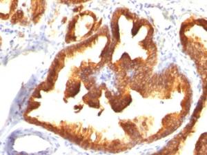 Immunohistochemical analysis of formalin-fixed, paraffin-embedded human prostate carcinoma using Anti-Cytokeratin 18 Antibody [KRT18/836]