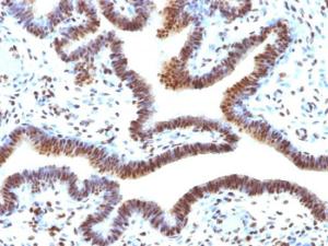 Immunohistochemical analysis of formalin-fixed, paraffin-embedded human ovarian carcinoma using Anti-SUMO-2 Antibody [SUMO2/1199]