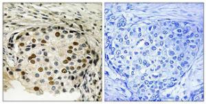 Immunohistochemical analysis of paraffin-embedded human breast carcinoma using Anti-OSR1 (phospho Thr185) Antibody. The right hand panel represents a negative control, where the antibody was pre-incubated with the immunising peptide.