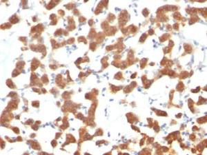 Immunohistochemical analysis of formalin-fixed, paraffin-embedded human thyroid carcinoma using Anti-Cytokeratin 18 Antibody [C-04]