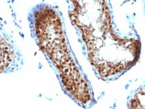 Immunohistochemical analysis of formalin-fixed, paraffin-embedded human testicular carcinoma using Anti-SUMO-2 Antibody [SUMO2/1199]