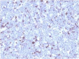 Immunohistochemical analysis of formalin-fixed, paraffin-embedded human lymphoma using Anti-CD43 Antibody [rSPN/1094]