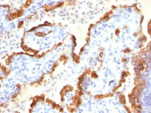 Immunohistochemical analysis of formalin-fixed, paraffin-embedded human lung cancer using Anti-Cytokeratin 18 Antibody [Cocktail KRT18]