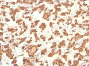 Immunohistochemical analysis of formalin-fixed, paraffin-embedded human thyroid cancer using Anti-Cytokeratin 18 Antibody [Cocktail KRT18]