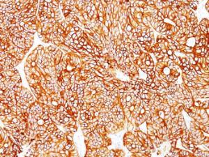 Immunohistochemical analysis of formalin-fixed, paraffin-embedded human colon carcinoma using Anti-Cytokeratin 18 Antibody [Cocktail KRT18]