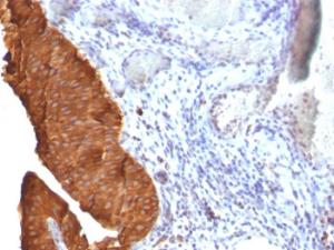 Immunohistochemical analysis of formalin-fixed, paraffin-embedded human bladder carcinoma using Anti-Cytokeratin 19 Antibody [SPM561]