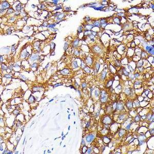 Immunohistochemistry analysis of paraffin-embedded human liver cancer using Anti-Leptin Receptor Antibody [ARC0454] (A305700) at a dilution of 1:100 (40x lens). Perform microwave antigen retrieval with 10 mM PBS buffer pH 7.2 before commencing with IHC staining protocol.